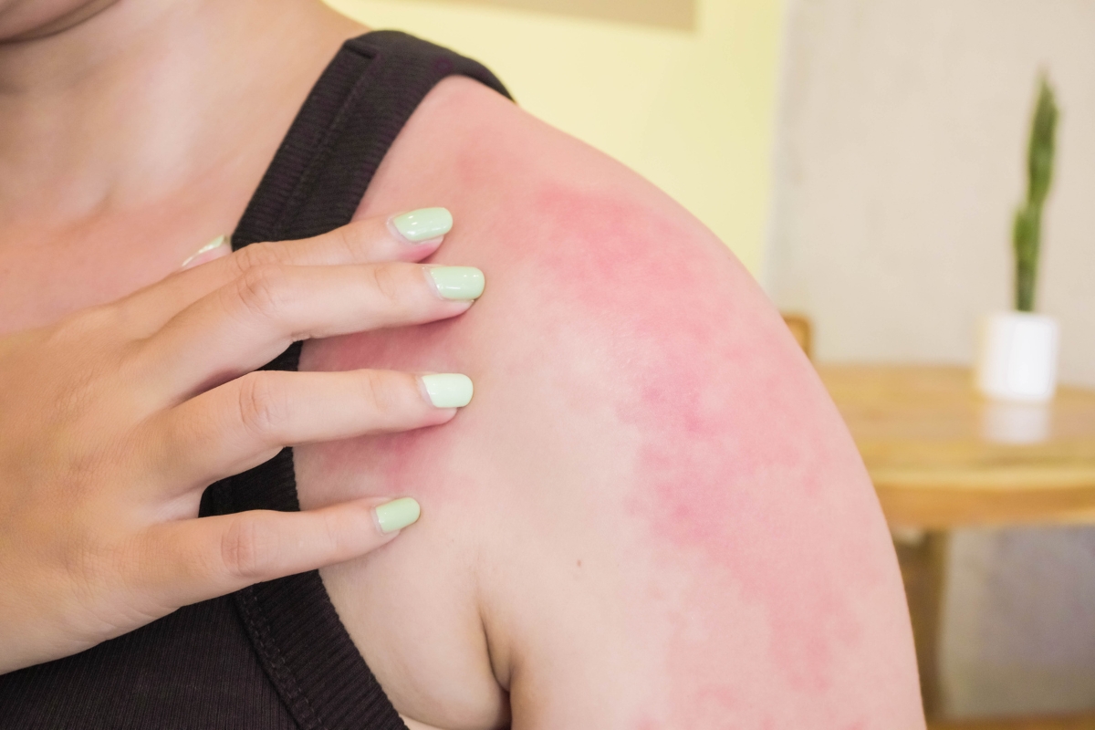 cancer de piel y sol